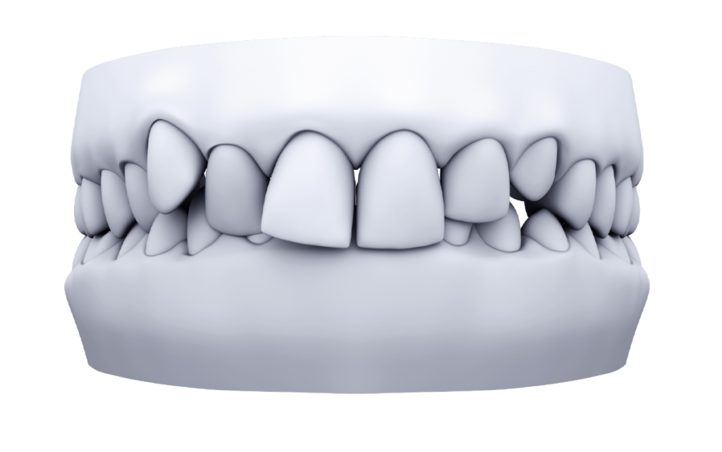 Treat Deepbite Issues