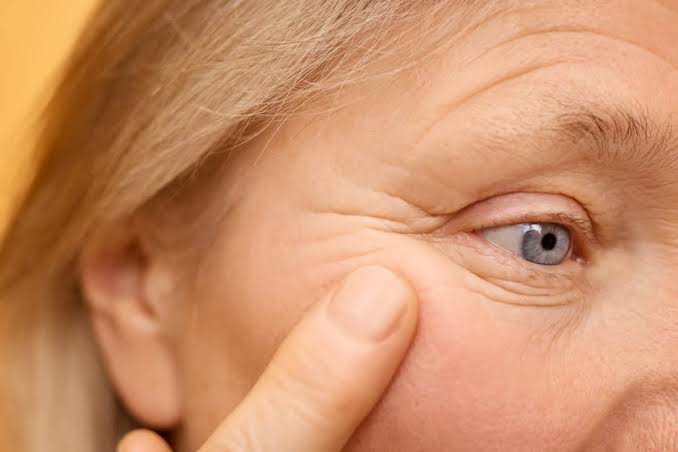 Botox Injections